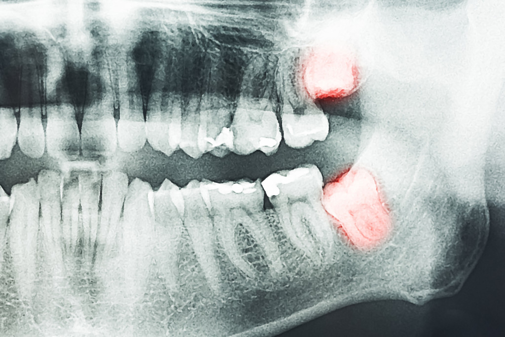 x-ray of a mouth showing wisdom teeth
