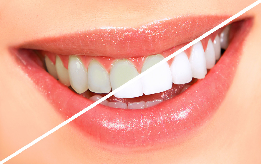 Before and after photos from teeth whitening