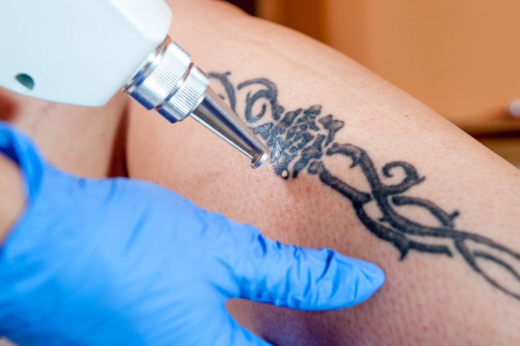 erasing tattoo using laser