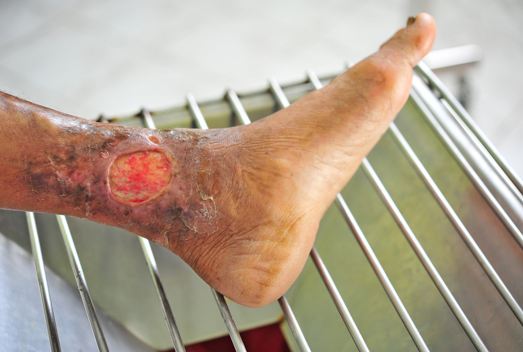 A chronic wound on a leg on a metal rest